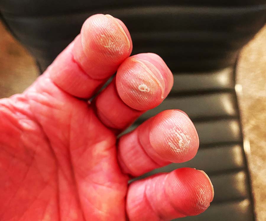 blisters-from-playing-the-guitar-900px